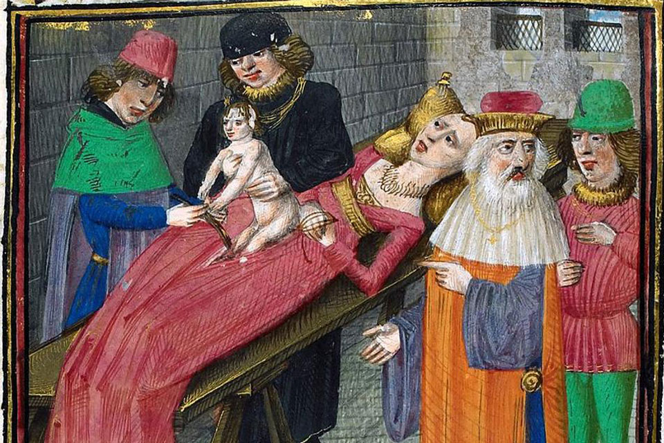Medieval depiction of Caesarean birth. c. 1473-1476. (Image from the British Library, Royal MS 16 G VIII f.32r. Source: Wikimedia Commons