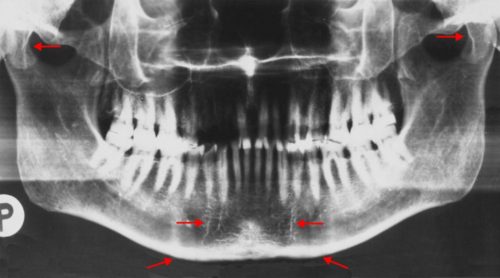 Charles IV of bohemia lower jaw