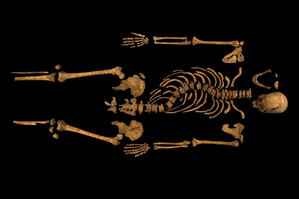 Scoliosis of Richard III